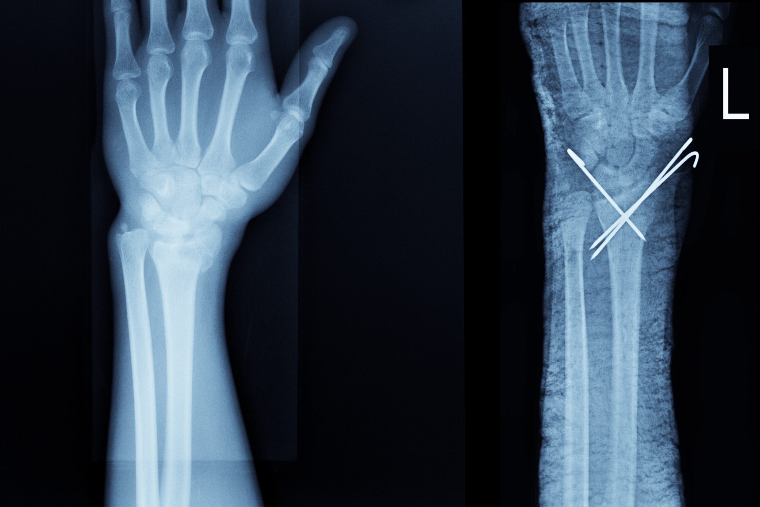 Xray Broken Wrist What Are The Most Common Types Of Wrist And Hand